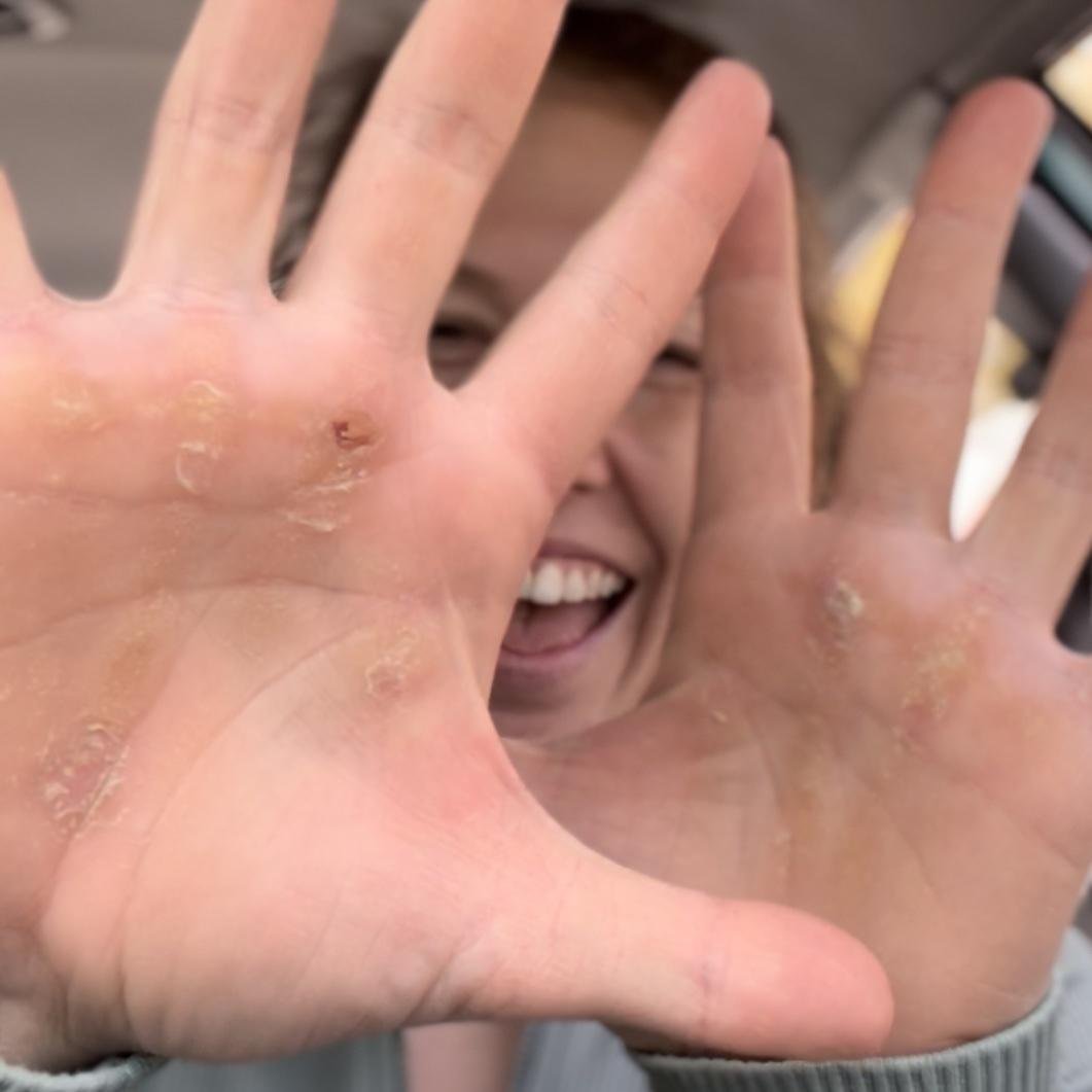 Callus & Rip Care 101