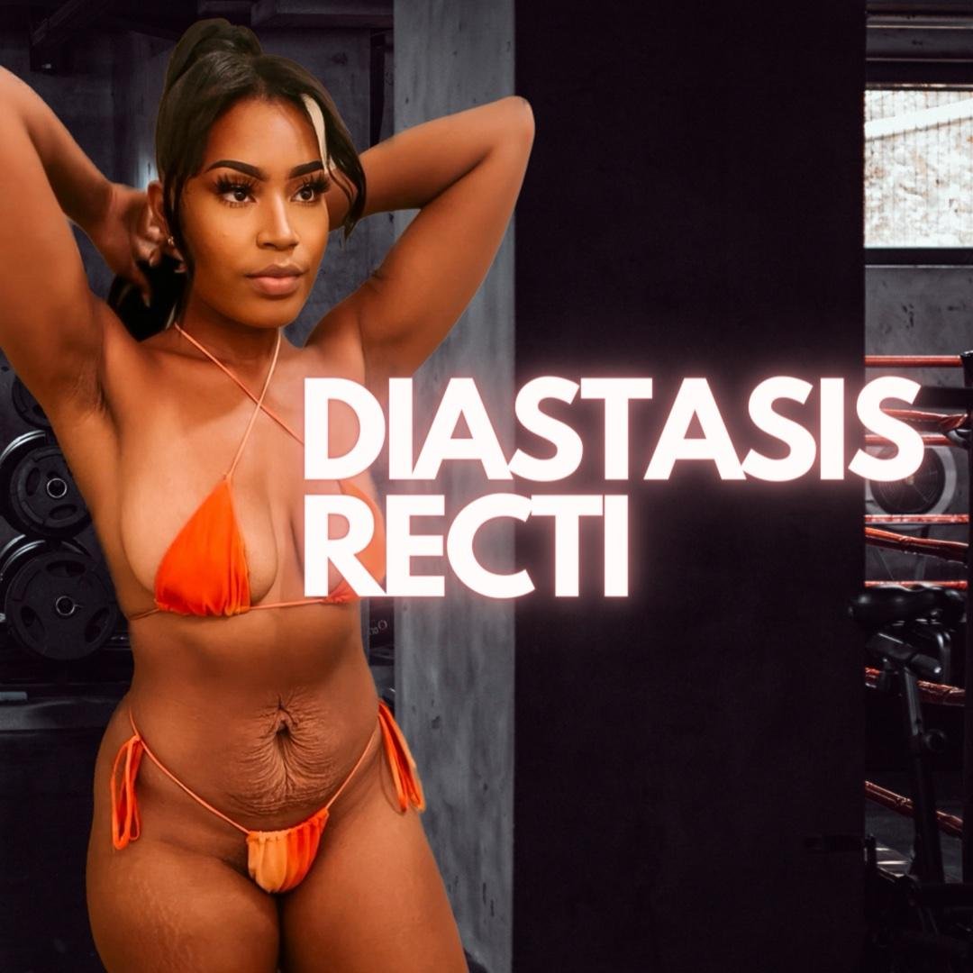 Diastasis Recti