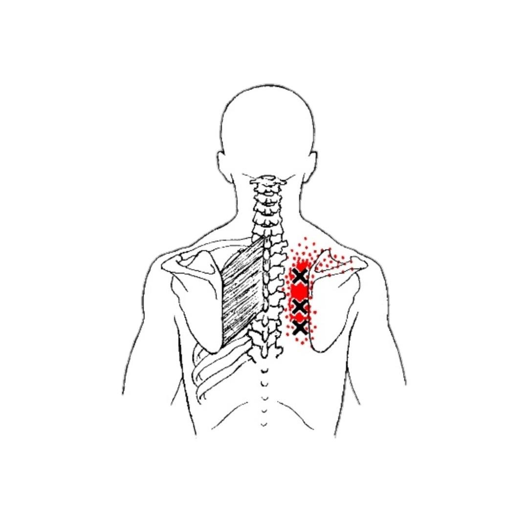 Neck and Shoulder Blade Recovery - Start Here!