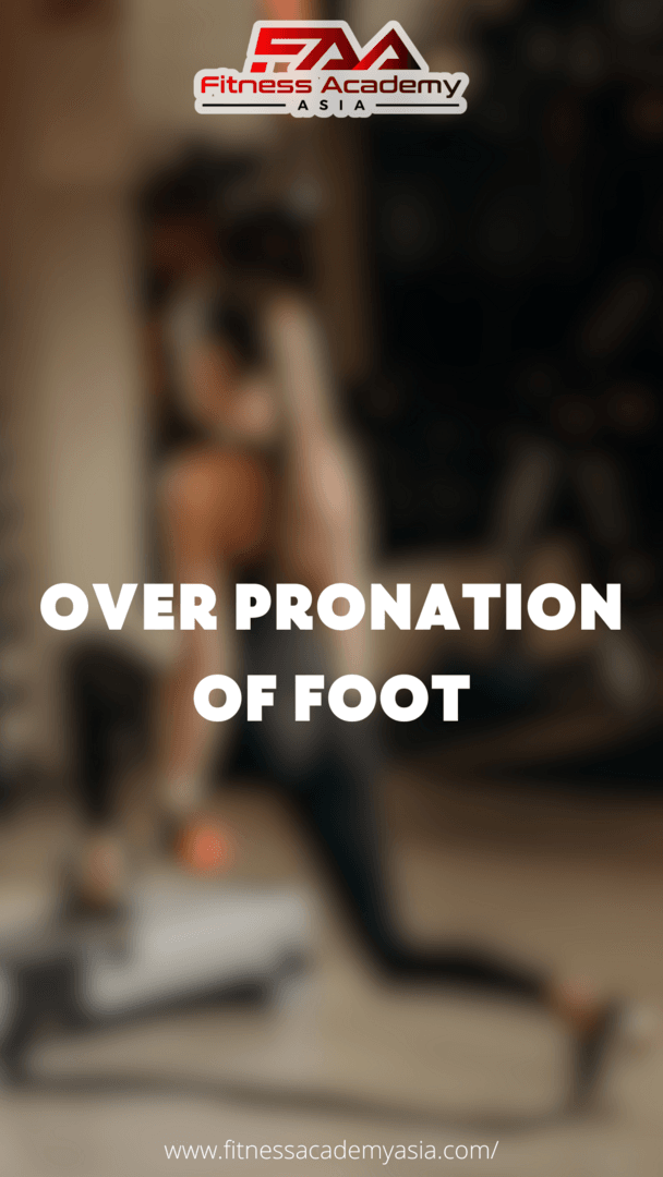 Bàn chân đổ trong  - Over Pronation of Foot 