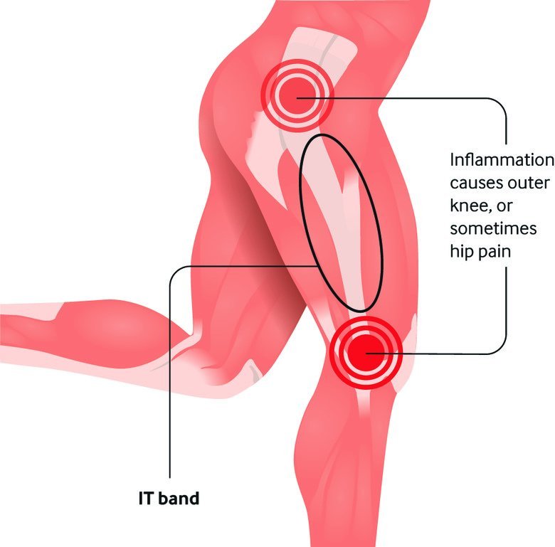 IT Band Syndrome Relief